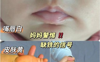 宝宝嘴唇多肉是正常现象吗？