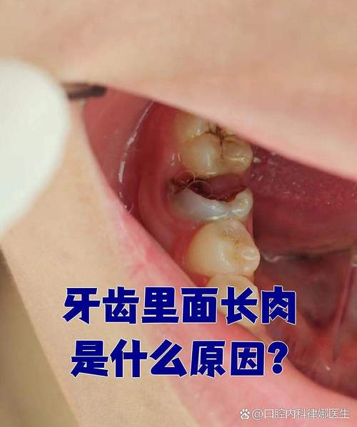 烂牙齿中间长出了多肉-第3张图片-吾爱花网